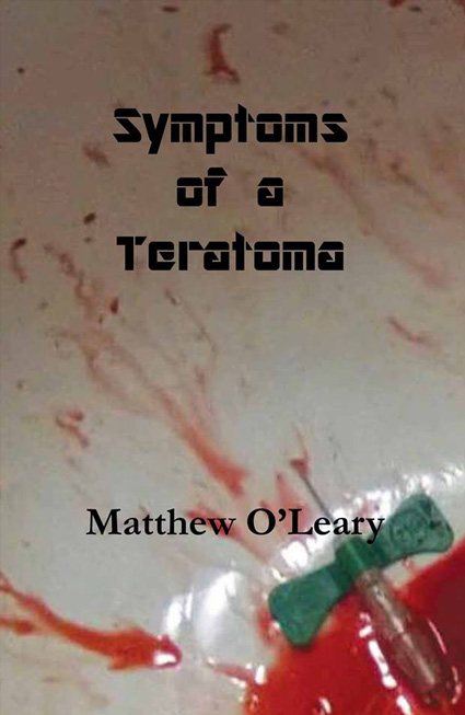 Symptoms of a Teratoma